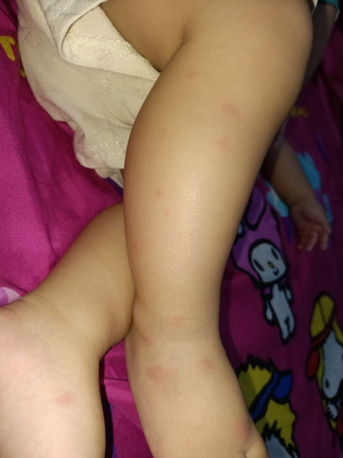 Bentol bentol merah di kaki