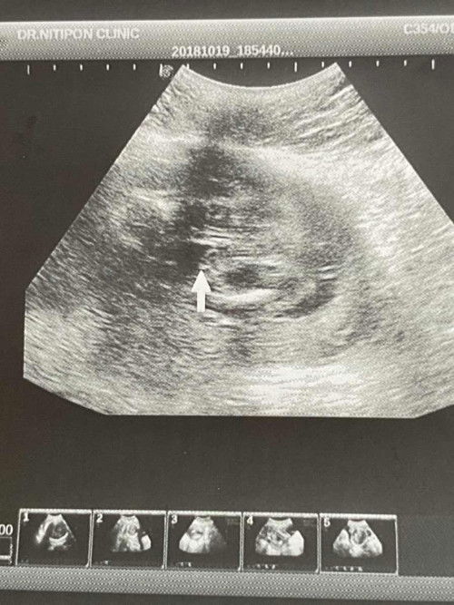 สอบถามเรื่องเพศน้องค่ะ