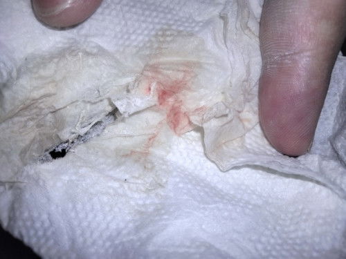 37+1 มีมูกเลือด ไป รพ ได้เลยมั้ยคะ