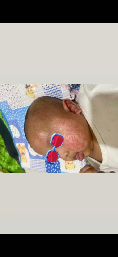 Eksim kulit/ruam pipi