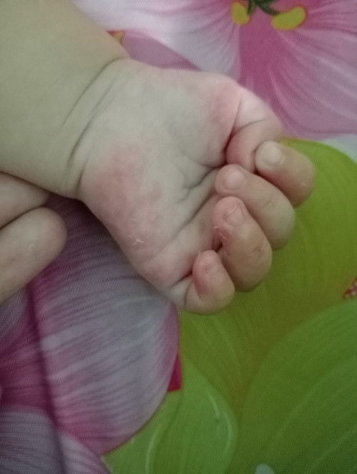 Bé 5tháng . Tay chân bé phát ban đỏ như vậy là bị sao ạ 
E tập đầu làm mẹ không biết 😢