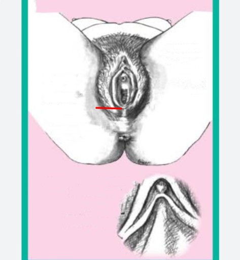 เจ็บแถวตรงที่หมอทำคลอดเองค่ะ ลูกคนแรกที่หมอทำไว้