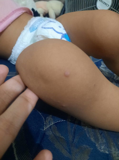 Flu singapura atau cacar?