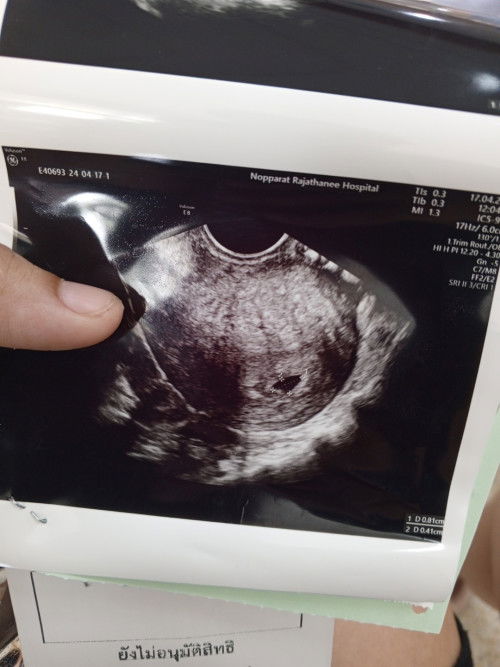 อัพเดท หลังจากผ่าตัดนอกมดลูก ผ่าแล้วไม่เจอน้อง