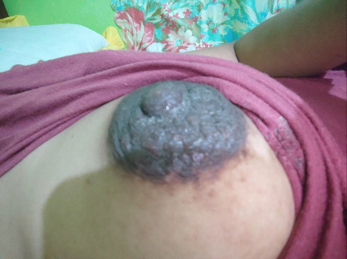 Breast pain and Itch
