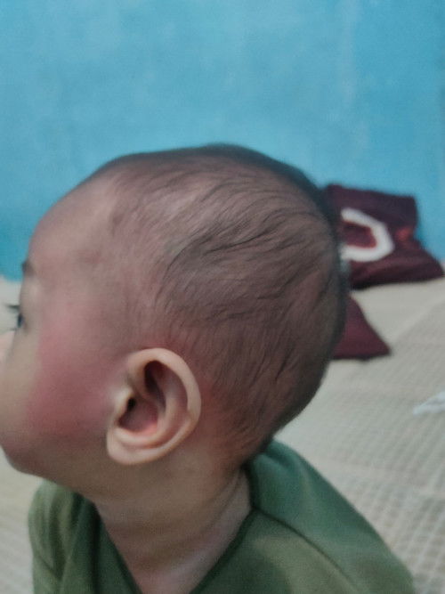 Biduran di seluruh badan