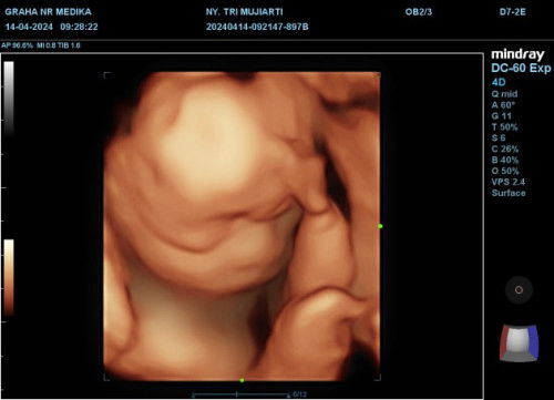 Bun mau tanya dong Disni yg hamil 23 weeks BB janin pada berapa yah?