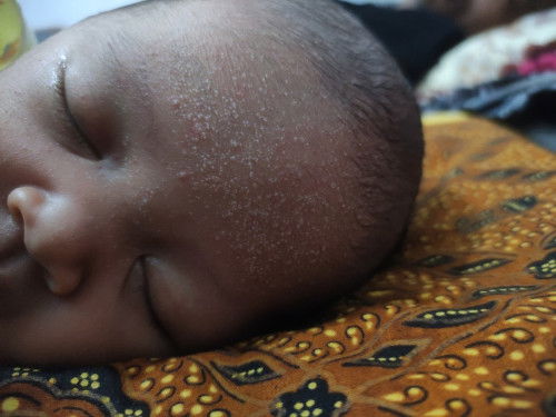 Merintis/Bintik2 didahi