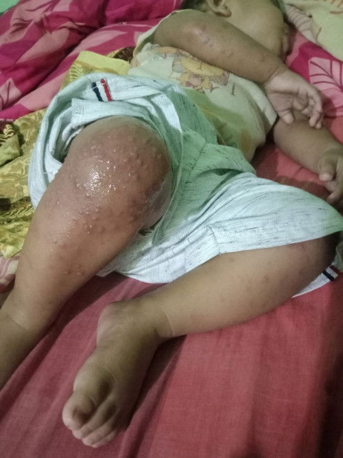 Bintik bintik pada bayi, serius tanya?!!