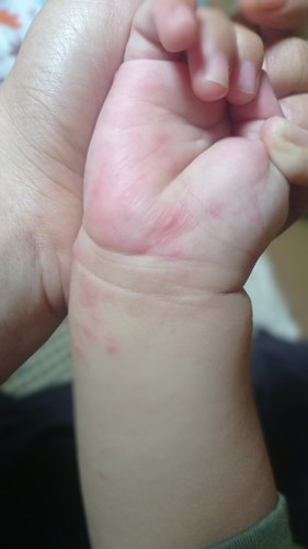 Halo bunda, anakku usia 9 bulan 7 hari kena cacar. Gimana treatment-nya ya? Mohon pencerahannya 🙏🏻