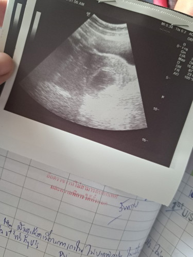 ท้องลม 9w5d