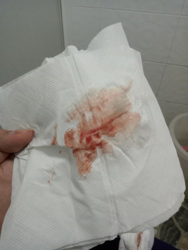 38+3 กระตุ้นคลอด