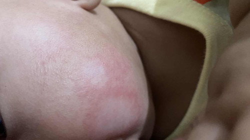 PIPI RUAM obat apa yang manjur