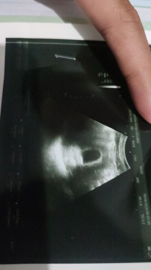 td pertamakalinya usg usia 8weeks tp hanya kantong.