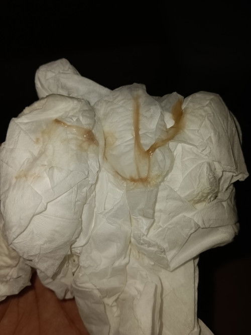 38+4Week มีมูกออก