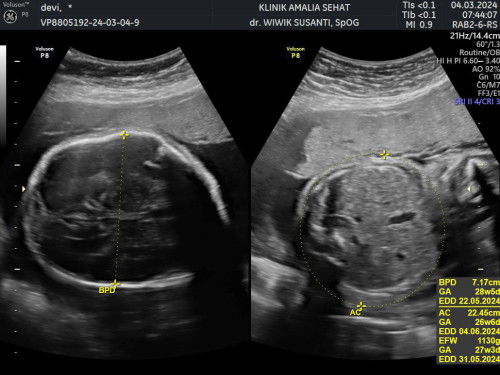 Ukuran lingkar kepala janin lebih besar dari lingkar perut