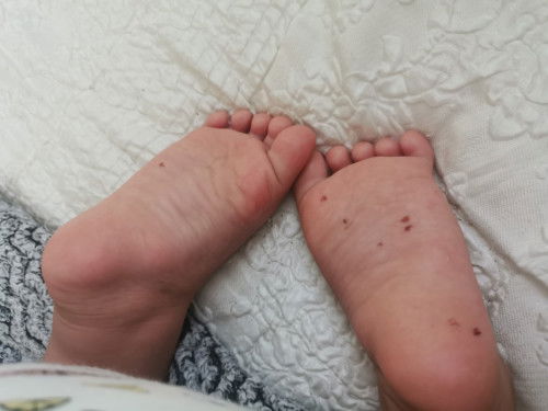 Mga momsh may idea po kayo ano tong red spots na parang moles at stains sa sole ng 1 & half year old