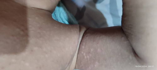 Bruntusan pada bayi 10bln 4hari