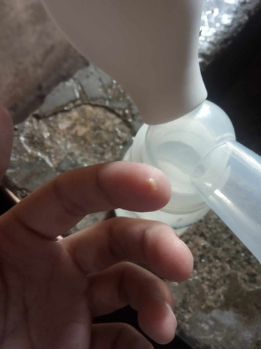 Discharge ng 5 month old baby girl