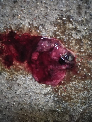 miscarriage