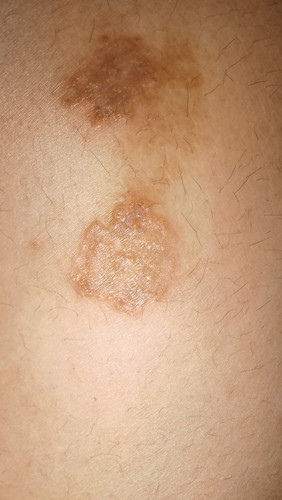 Sino po dito nag ka rashes sa legs.