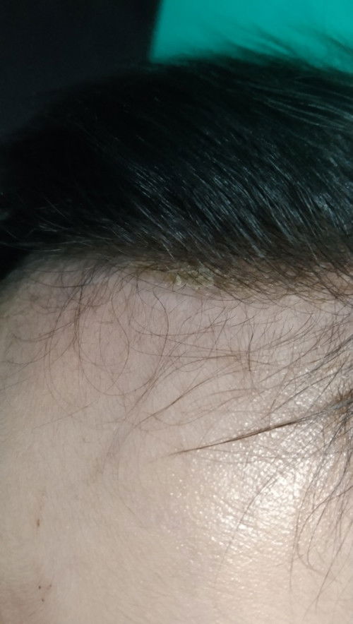 bund ada yg sama gk ya kulit kepala depan bayi aku kayak terkelupas gini pakein apa