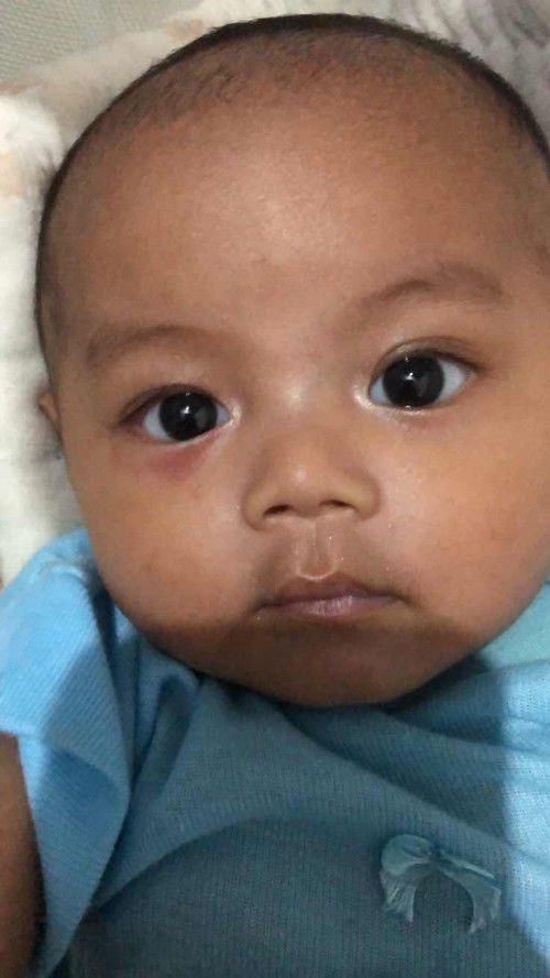 Mata bayi ad kemerahan