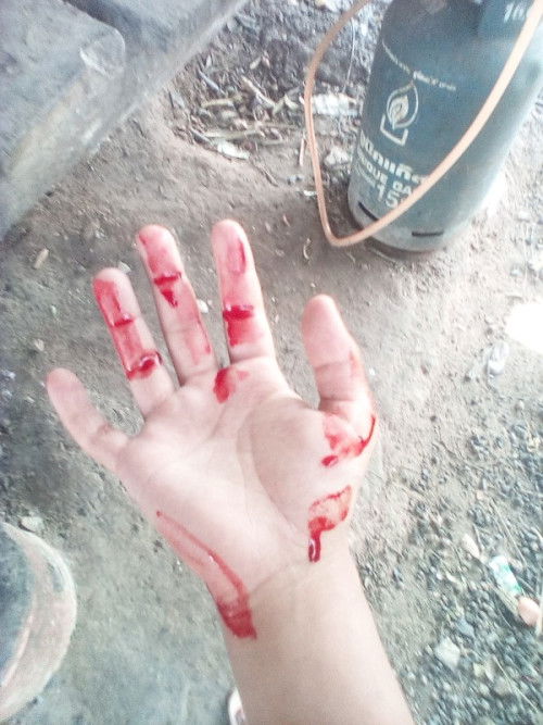 03:30 นอนอยุ่ดีๆเลือดกำเดาไหล
36*²