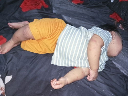 Bedak dingin untuk menghilangkan bekas cacar air