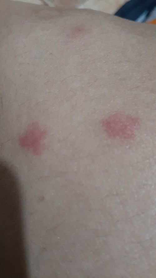 Ada yg sama kyak aku gak bun,ini gatal sekali🥲