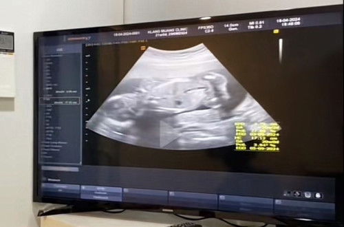 ผลเจาะน้ำคร่ำเสี่ยงโครโมโซมคู่ที่21 ที่ 1:31