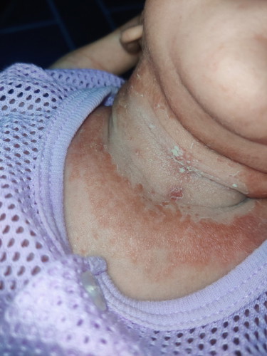 Ruam bahagian leher baby
