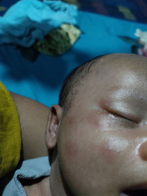Ruam pd bayi newborn