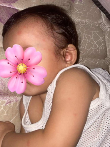 ada sesiapa tahu tak kenapa baby saya naik merah2 macam ni?