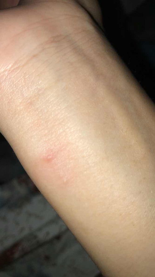 Gatal dan bintik ber air