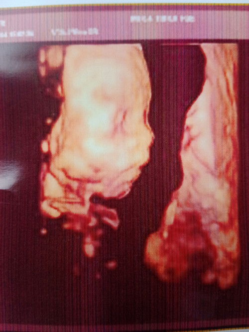 E đi siêu âm bs nói giới tính e bé là 2 cánh bướm (rồi có cái ngồi) là trai hay gái zay mn?