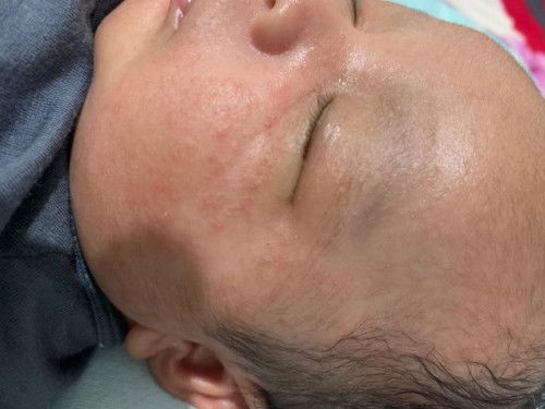 Bintik Merah di Wajah Anak