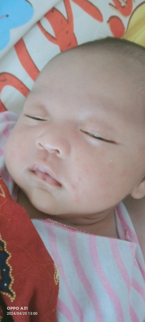 rekomendasi cream untuk hilangkan eksim susu bun