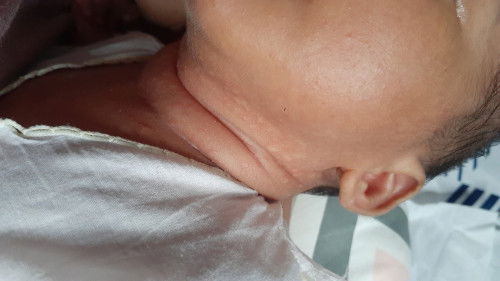 (Saya Newmom)Apa ini biang keringat?