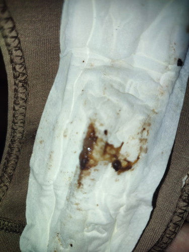 Normal lang poba yong may lalabas na parang sipon na ie po kse ako kahapon 1cm na daw po ako