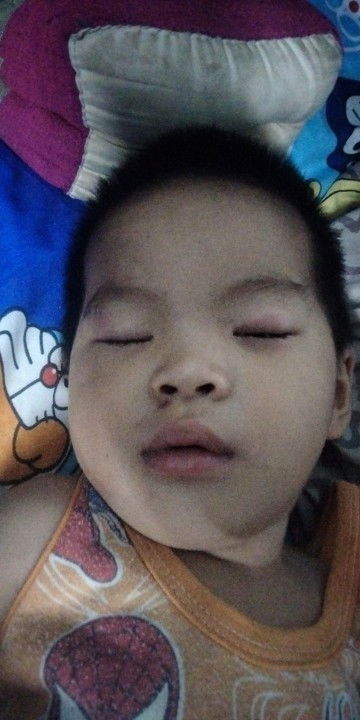 ลูกตาแฉะเปลือกบวมแดง