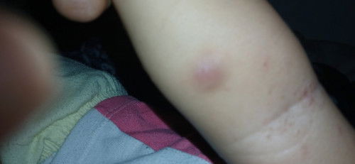 paano mawala ang pamamaga sa balat dahil sa PPD test?