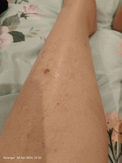 Kulit kering bertompok