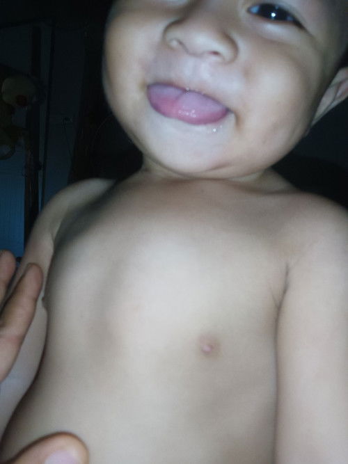 หน้าอกนูน