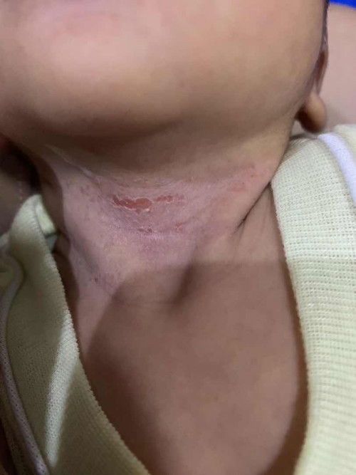 Ruam pada leher newborn