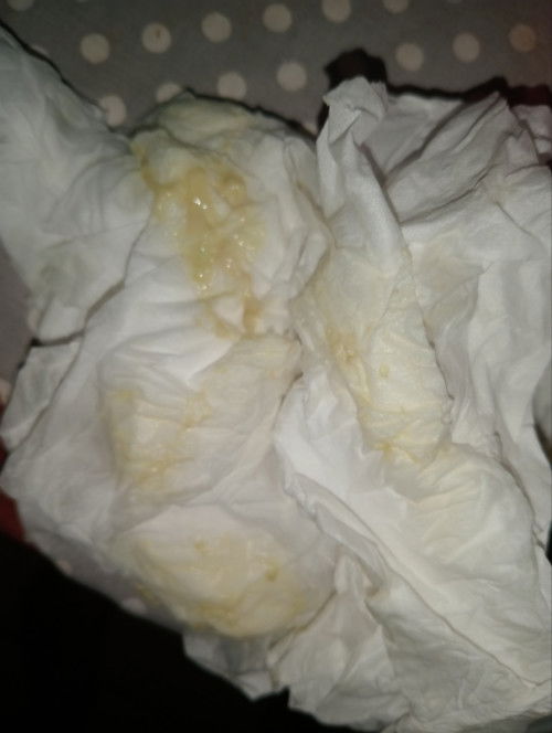 Keputihan atau ketuban rembes