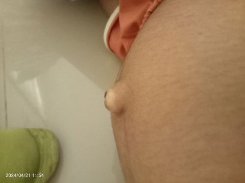 สะดือจุ่นออกมา