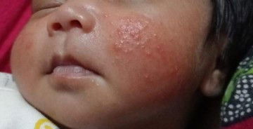 ruam pipi bayi