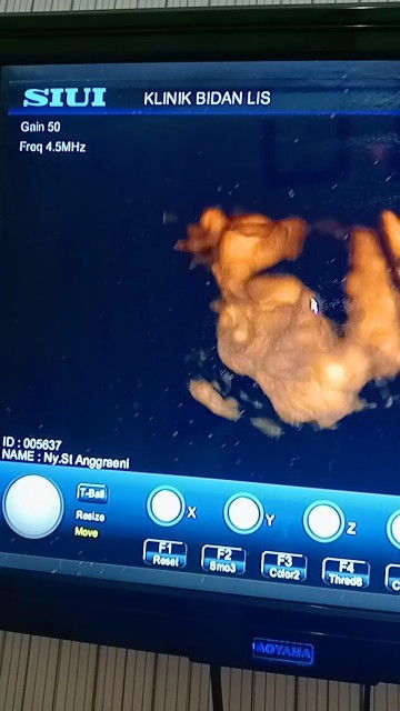 JK USG 4D kurang jelas