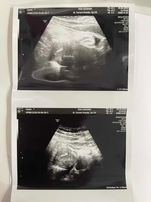 Tespek positif, USG masih penebalan